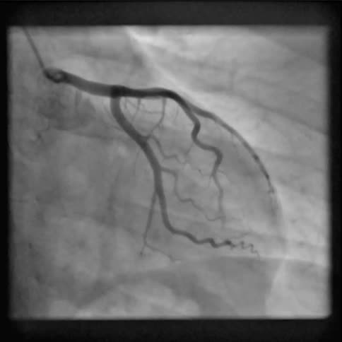 Internal camera of the human body with forceps performing the surgical procedure