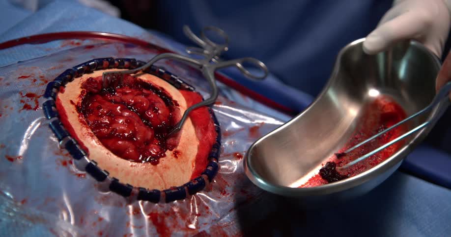 A doctors hand in a white glove uses tweezers to remove excrement from an open brain undergoing surgery