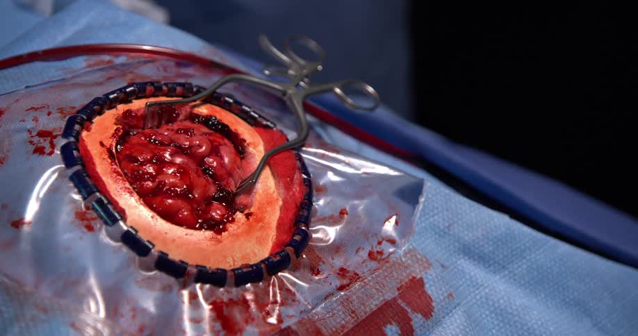 Scalpel placed in the brain of a patient undergoing a surgical procedure