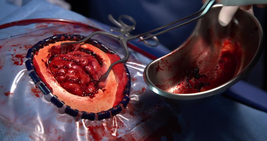 A doctor is performing brain surgery on a patient while a nurse is holding a tray
