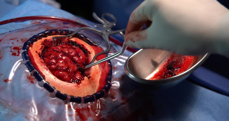 A doctors hand with white gloves using tweezers to remove a red element from a brain that is in surgery