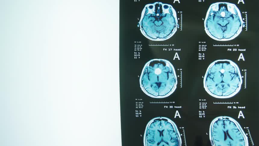 Xray report being placed on a screen with white light