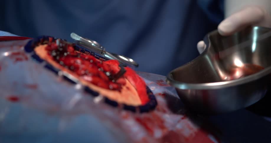 Hands of two surgeons with the help of a tool removing a piece of a persons brain fragment in a careful surgical procedure