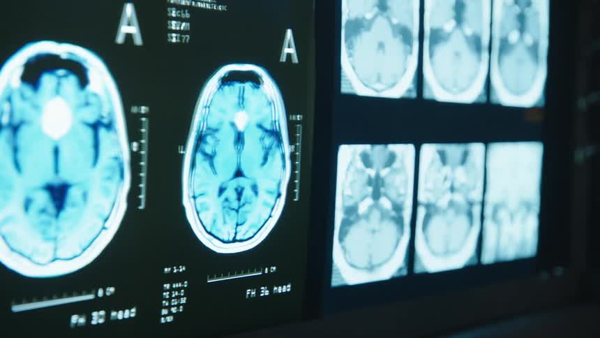 Brain xray reports on a screen in a hospital