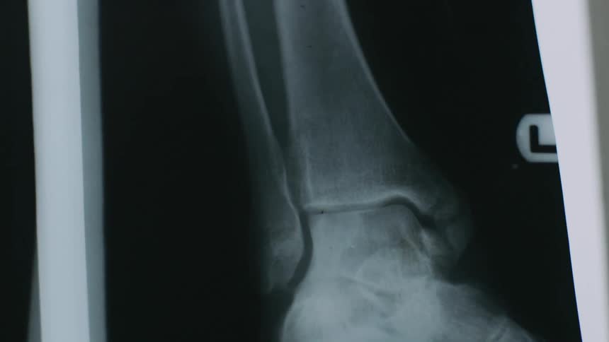 Radiograph of a human bone