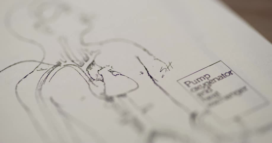 An anatomical drawing of a human torso highlights a pump oxygenator and heat exchanger in a labeled section