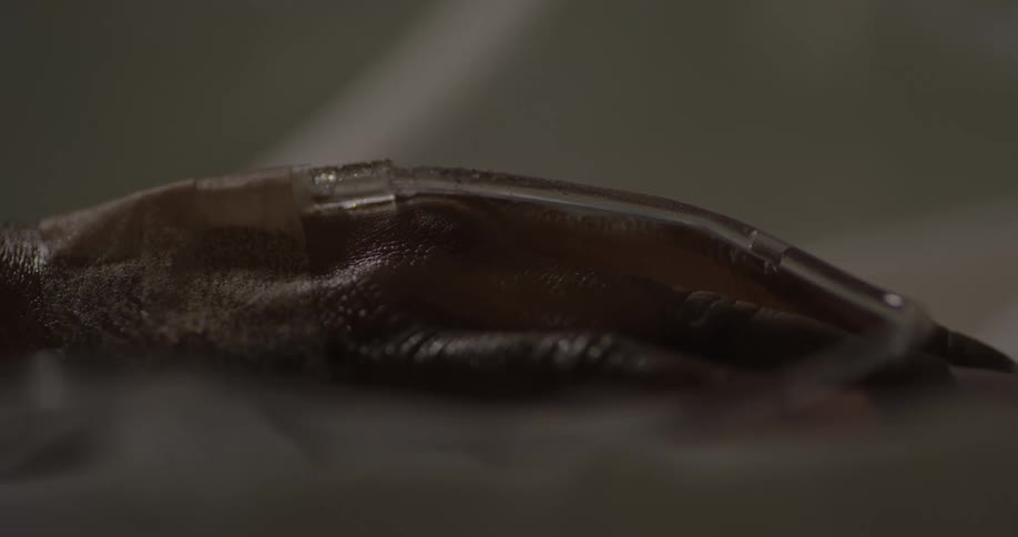 Fluid flows in a tube connected to a cannula attached to a persons hand