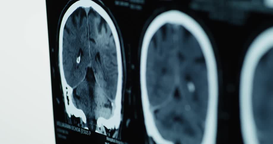 A doctor points to a ct scan
