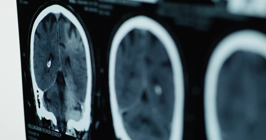 A person points and touches a brain ct film