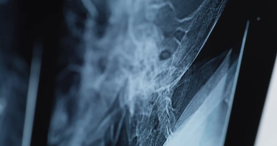 Close up of a bone xray