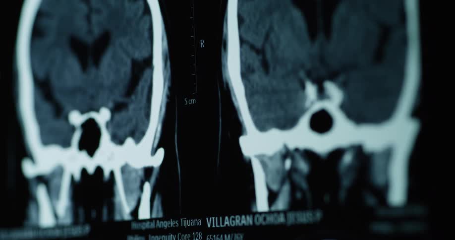 An xray image showing a persons skull in a bluish coloration