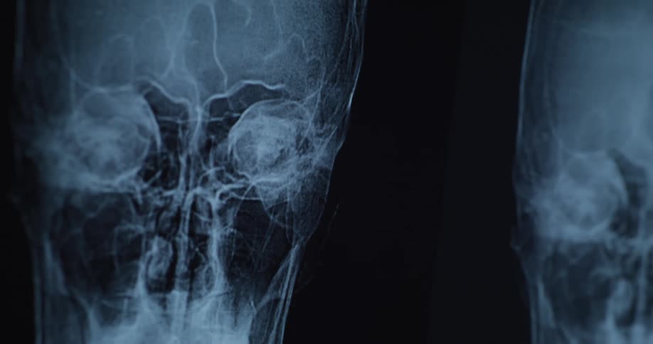 A xray of a human skull with several nerves and bluish coloration on a black page