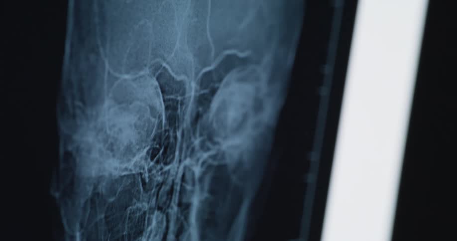 A screen displaying a scan of a patients skull