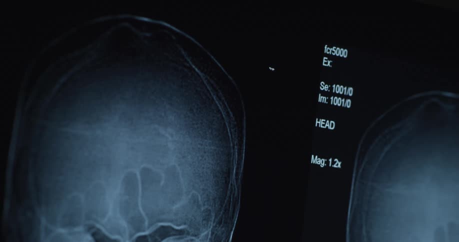 A ct scan is posted up for view