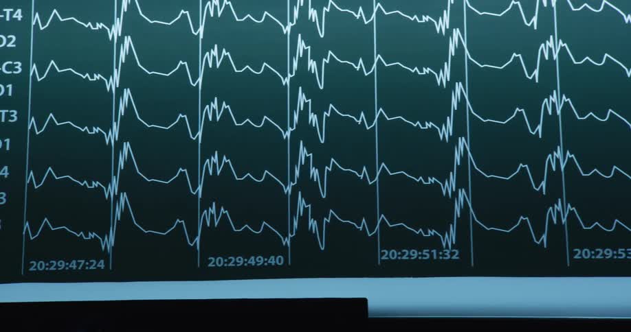 A graph of different ekgs are on the screen