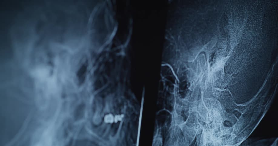 Close up blue tinged x rays show detailed views of a human skull with visible teeth and jawbone