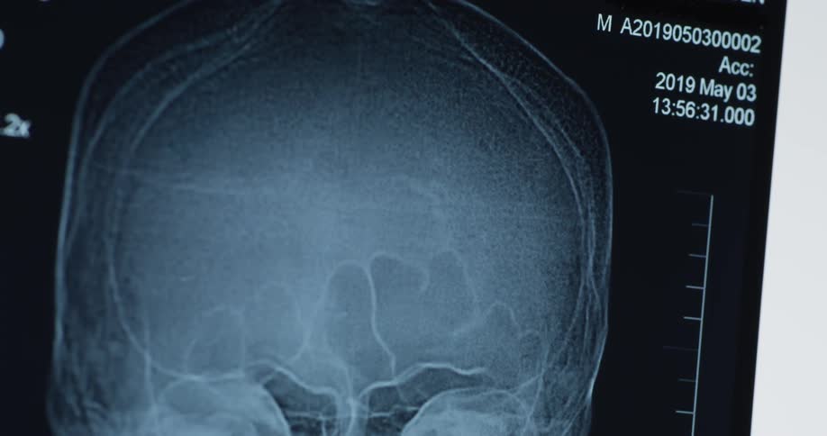 An xray of a persons skull in a black and white image