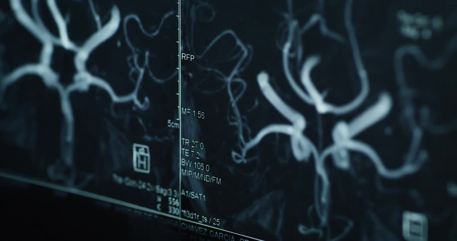 A gloved finger points to a medical scan displaying detailed imagery of cerebral blood vessels