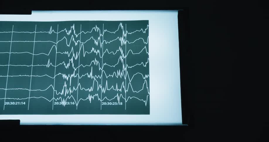 A persons heartrate is seen on a monitor