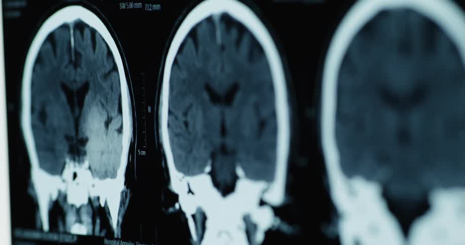 A persons finger pointing at an xray image of a heads brain