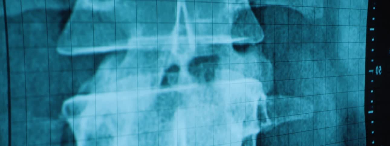 A tealtoned xray image displays a side view of a human spinal column with vertebrae and surrounding tissue visible against a gridded background