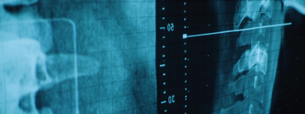 A tealtoned xray image displays a side view of a human spinal column with vertebrae and surrounding tissue visible against a gridded background