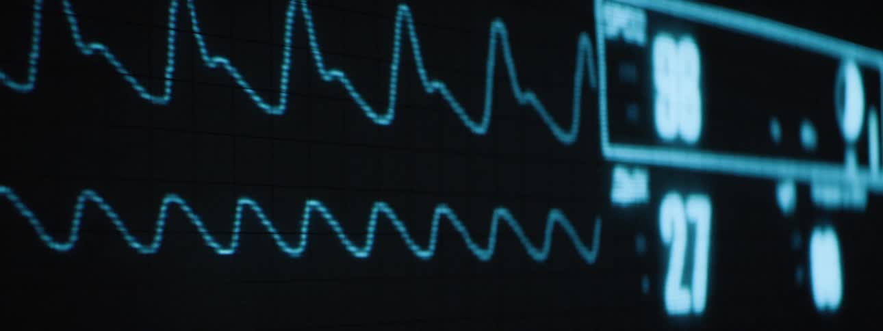 A medical monitor displays a cardiac rhythm in bright blue against a dark background