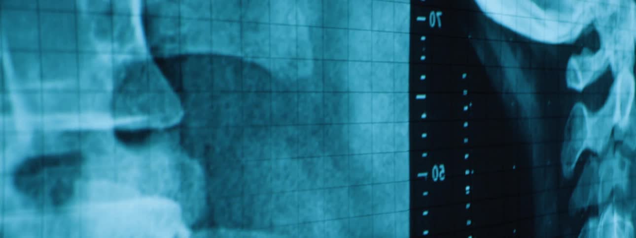 Close up of a screen displaying medical scan images of human vertebrae