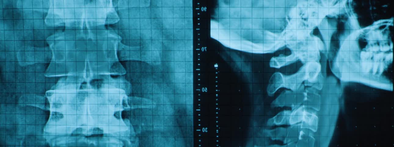 Radiographs show details of the spine in front and side views with a superimposed millimeter grid