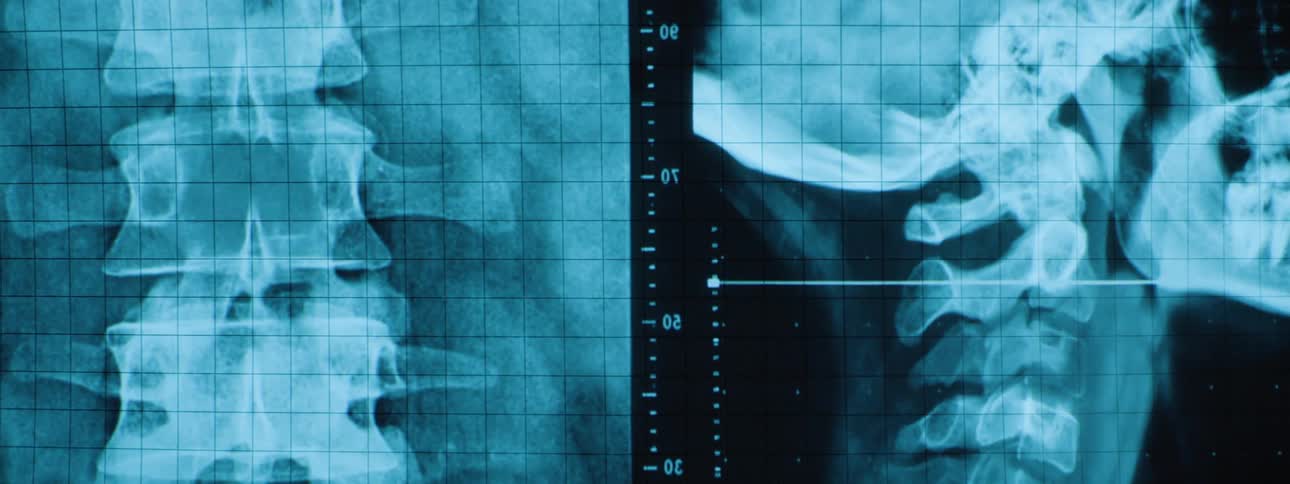 Screen displays a pair of x rays showing the neck of a patient