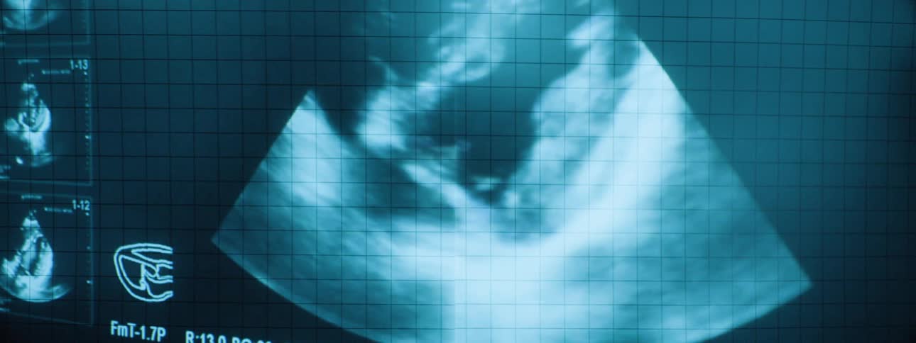 An ultrasound is capturing a video of the inside of a person
