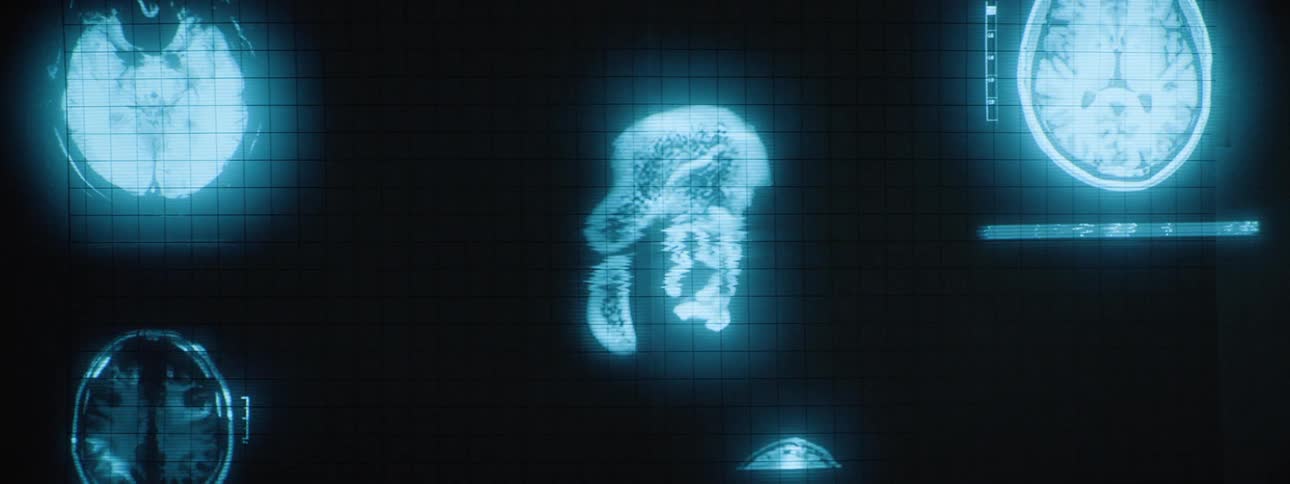 A medical imaging screen displays views of a human brain in bright cyan against a dark gridded background
