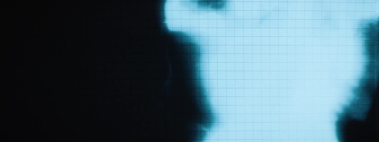 A radiology image of a human skull displayed on a monitor