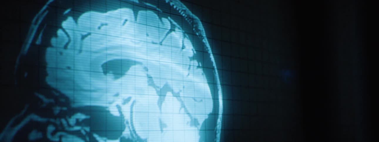 The scan of a persons head is shown on the monitor