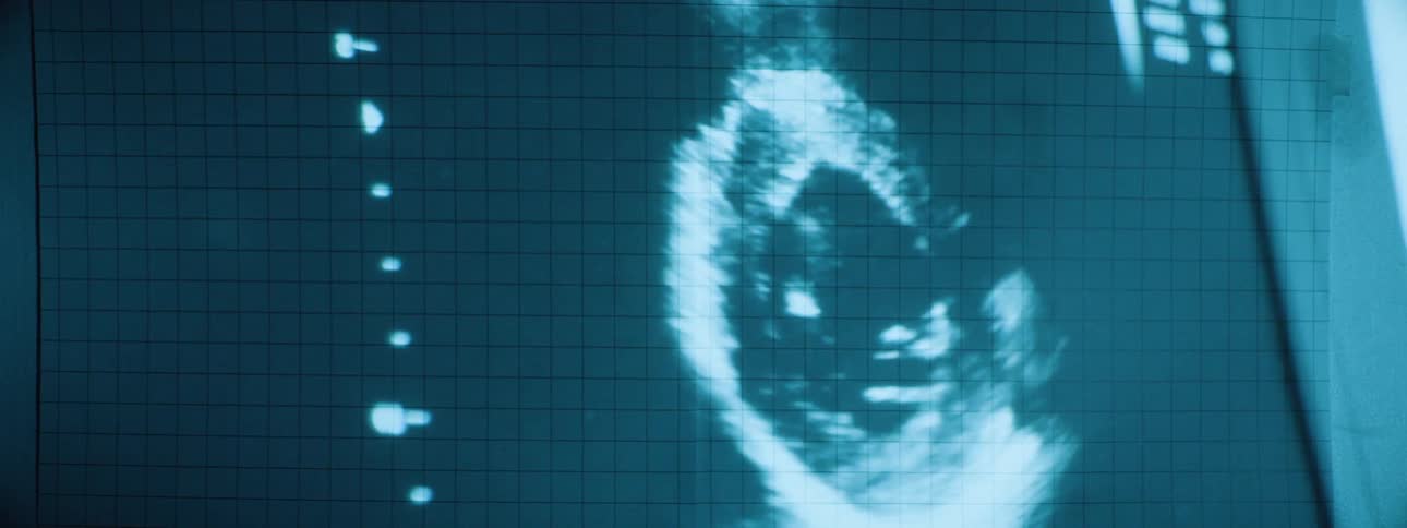 A computer monitor displays the image from an ultrasound