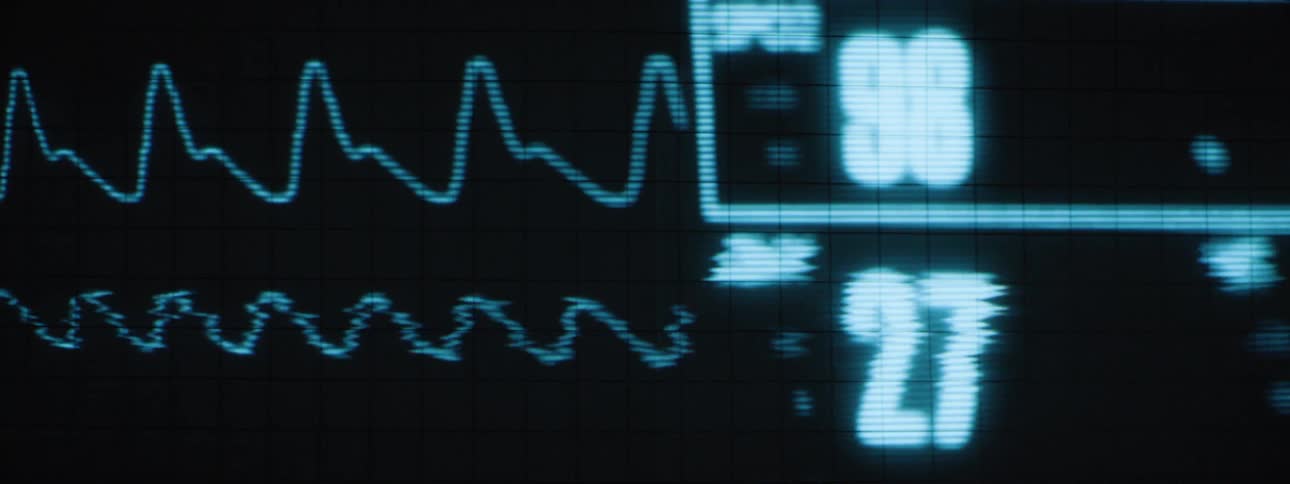 A medical monitor displays a heart rhythm waveform accompanied by numerical readings in bright blue on a dark gridded screen