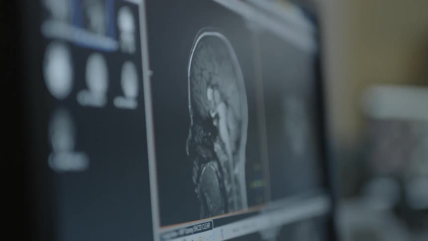 A brain on an mri screen