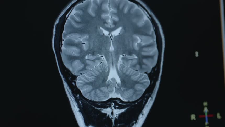 Computer generated image of a person's brain
