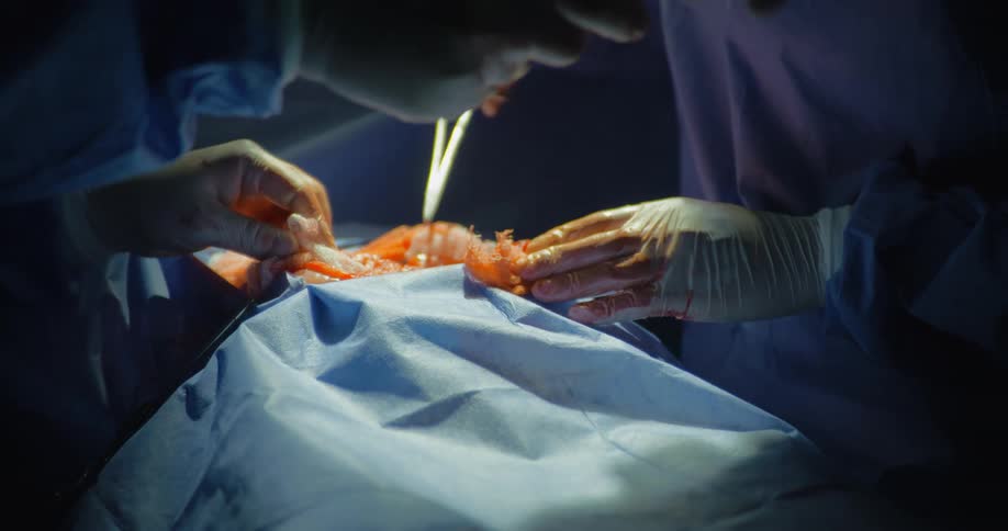 The video shows a closeup of a surgical procedure in progress with multiple medical professionals presumably surgeons working over a draped patient their gloved hands are visible meticulously using surgical instruments