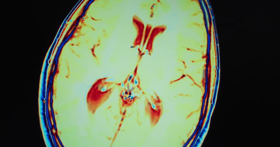 The video shows two distinct lines the first line is on the right side of the screen and is a thin blue line that curves the second line is red and appears to be slightly thicker and more erratic following the curves and contours of the brains interna