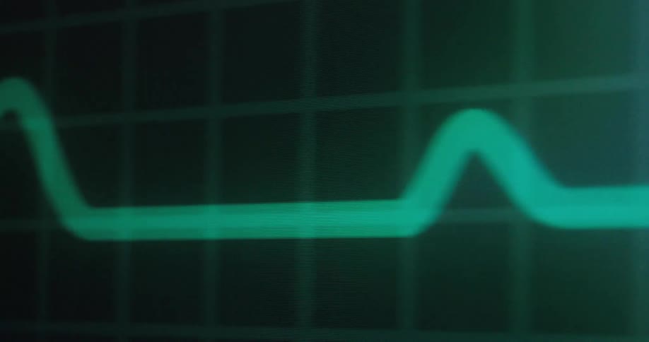 The heart monitor line is moving