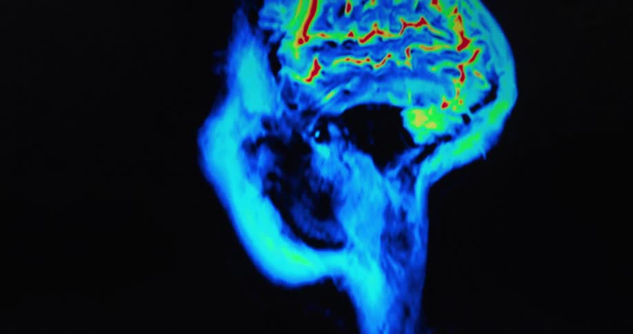 A colorenhanced brain scan in profile shows neural activity concentrated in the cortex with vivid reds and yellows highlighting active regions