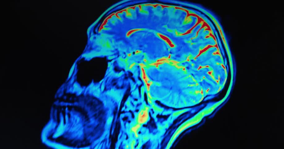 A colorful medical scan of a human head and brain rotates on a black background showing different cross sections with arteries and veins in red and blue