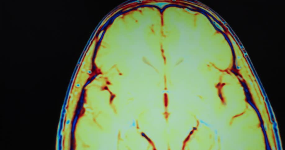 A colorful medical scan of a human head and brain rotates on a black background showing different cross sections with arteries and veins in red and blue
