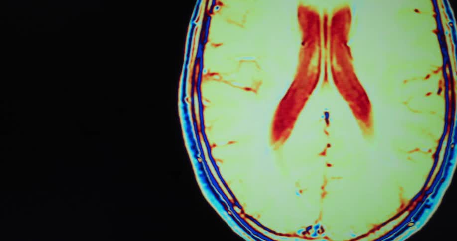 A brain mri scan displayed on a computer screen showing animated images of the brain
