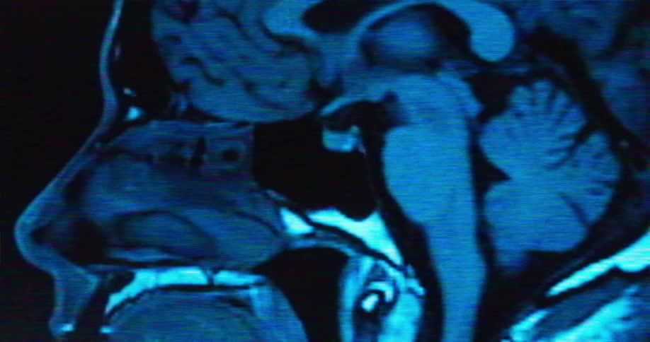 Blues of an animated medical image show the internals of a human head