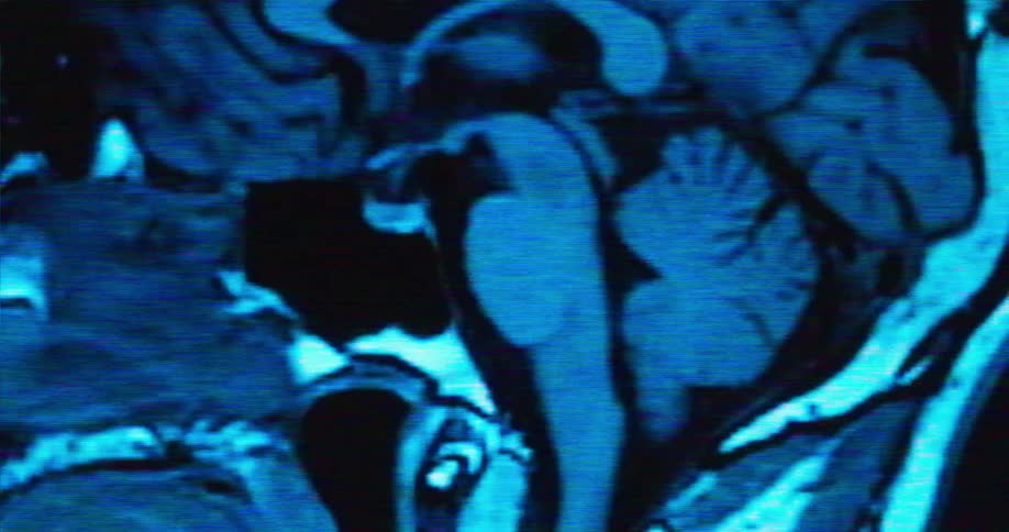 The medical scan is of a persons head