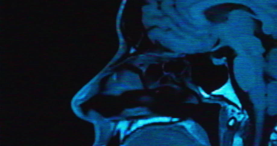 Magnetic resonance imaging showing in detail the bone structure and the eyeball