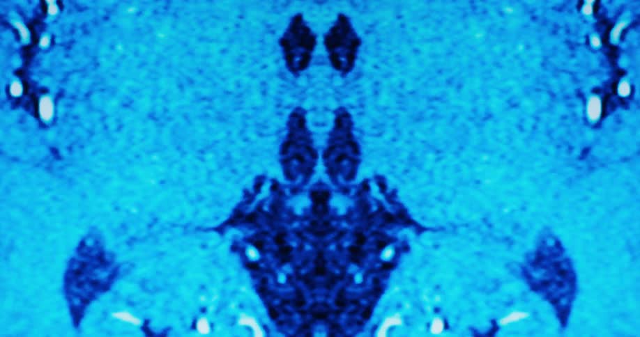A highcontrast bluetinted brain scan displays a symmetrical crosssection