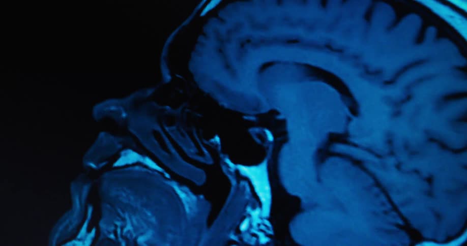 Mri showing lateral section of the human skull